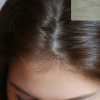 How Scalp Health Affects Postpartum Hair Loss Inflammation, Sebum Fluctuations, and Seborrheic Dermatitis