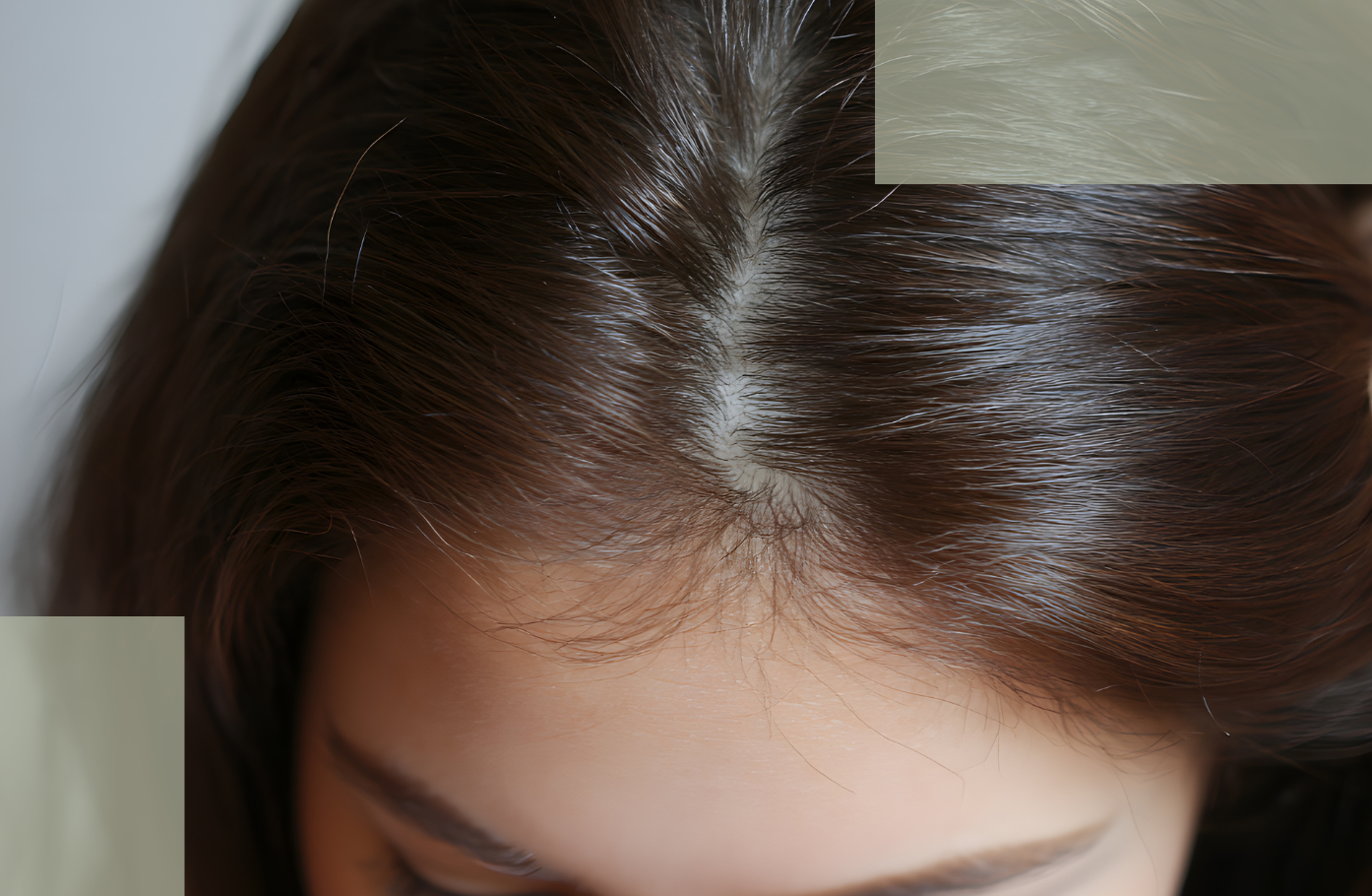 How Scalp Health Affects Postpartum Hair Loss Inflammation, Sebum Fluctuations, and Seborrheic Dermatitis