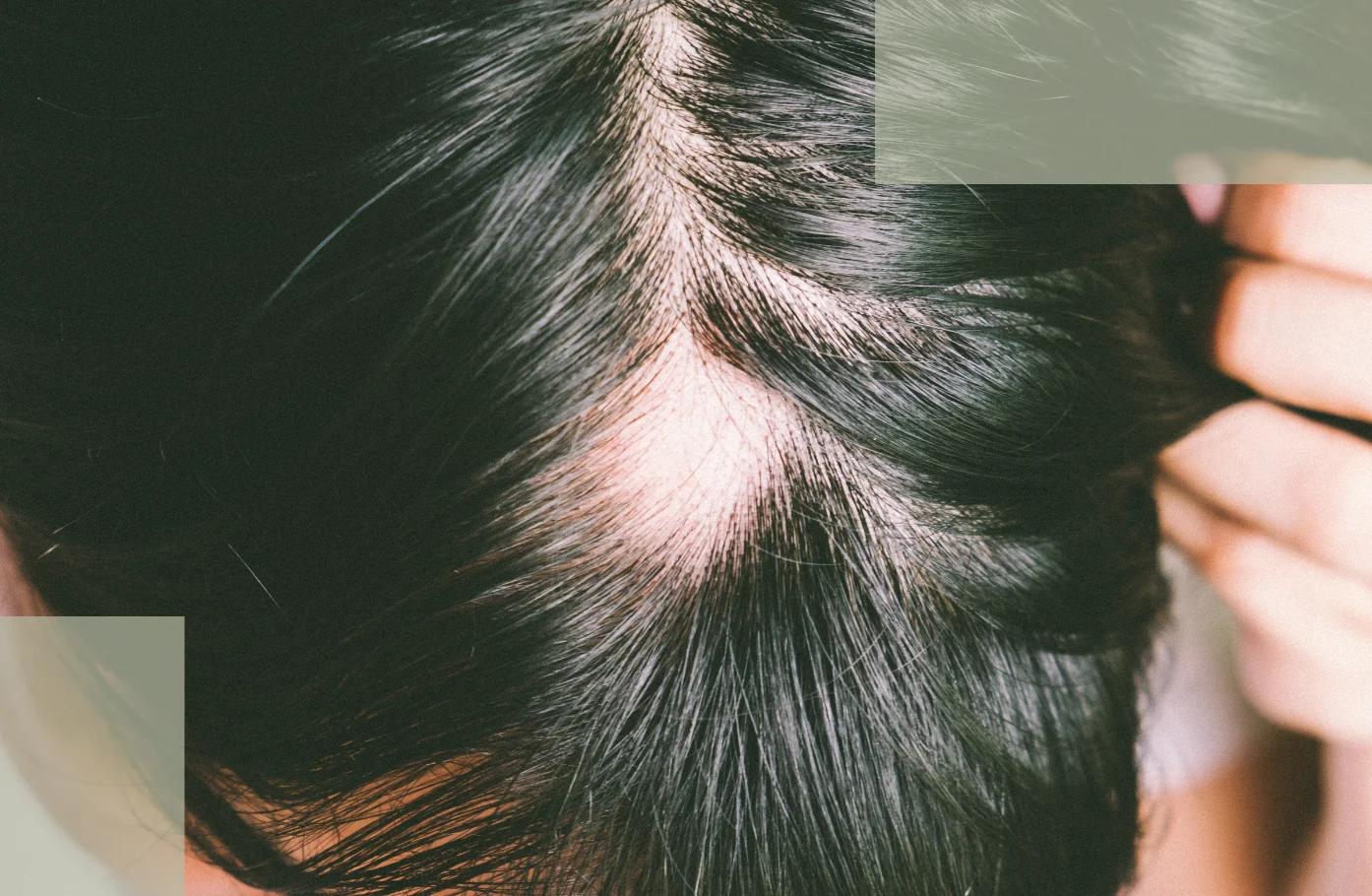 Scalp Environment Management Stabilizing the Micro-Ecosystem for Faster Postpartum Hair Recovery