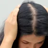 Hormonal Hair Loss Recovery: Step Two — The Scalp Must Stabilize First, or New Hair Won’t Hold