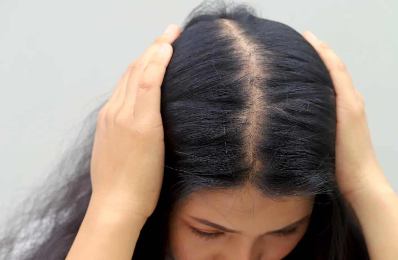 Hormonal Hair Loss Recovery: Step Two — The Scalp Must Stabilize First, or New Hair Won’t Hold