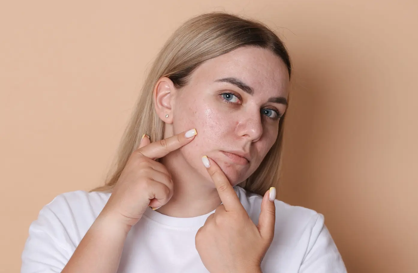 Insulin Resistance & PCOS–Related Hair LossWhy Metabolism and Hormones Together Slow Recovery