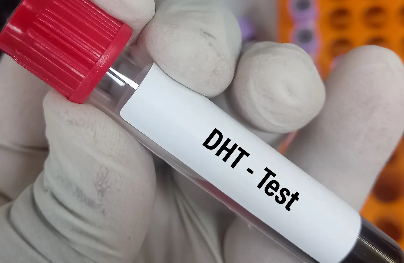 “Is It All DHT’s Fault_”The Most Oversimplified Explanation in Hormonal Hair Loss