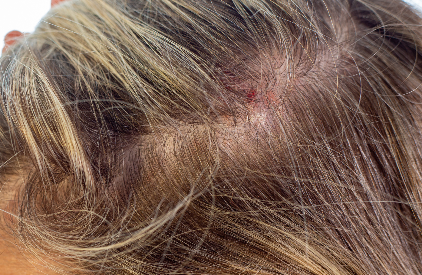 Safety and Sensitive Scalps Why “Gentle” Is Not Marketing — but a Recovery Requirement