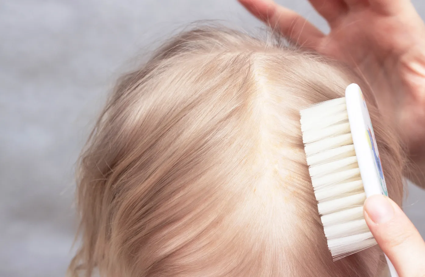 Seborrheic Dermatitis and Hormonal Hair Loss:Which Is the Cause — and Which Is the Amplifier?