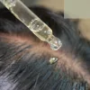 The Fifth Mechanism of Stress Hair Loss How Inflammation and Immune Signals Quietly Suppress Hair Growth