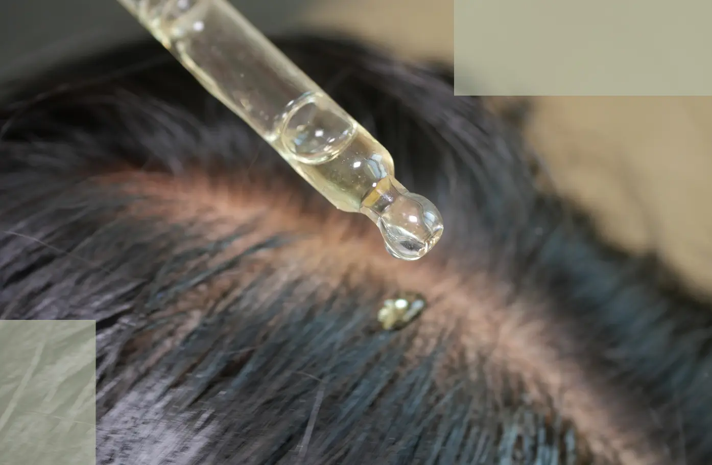 The Fifth Mechanism of Stress Hair Loss How Inflammation and Immune Signals Quietly Suppress Hair Growth