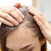 Chronic Blood Loss (Heavy Menstrual Flow) and Iron DeficiencyWhy This Is One of the Most Common Causes of Hair Loss in Women