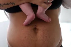 Postpartum BreastfeedingWhy Many Women “Eat Well” but Still Experience Persistent Hair Shedding