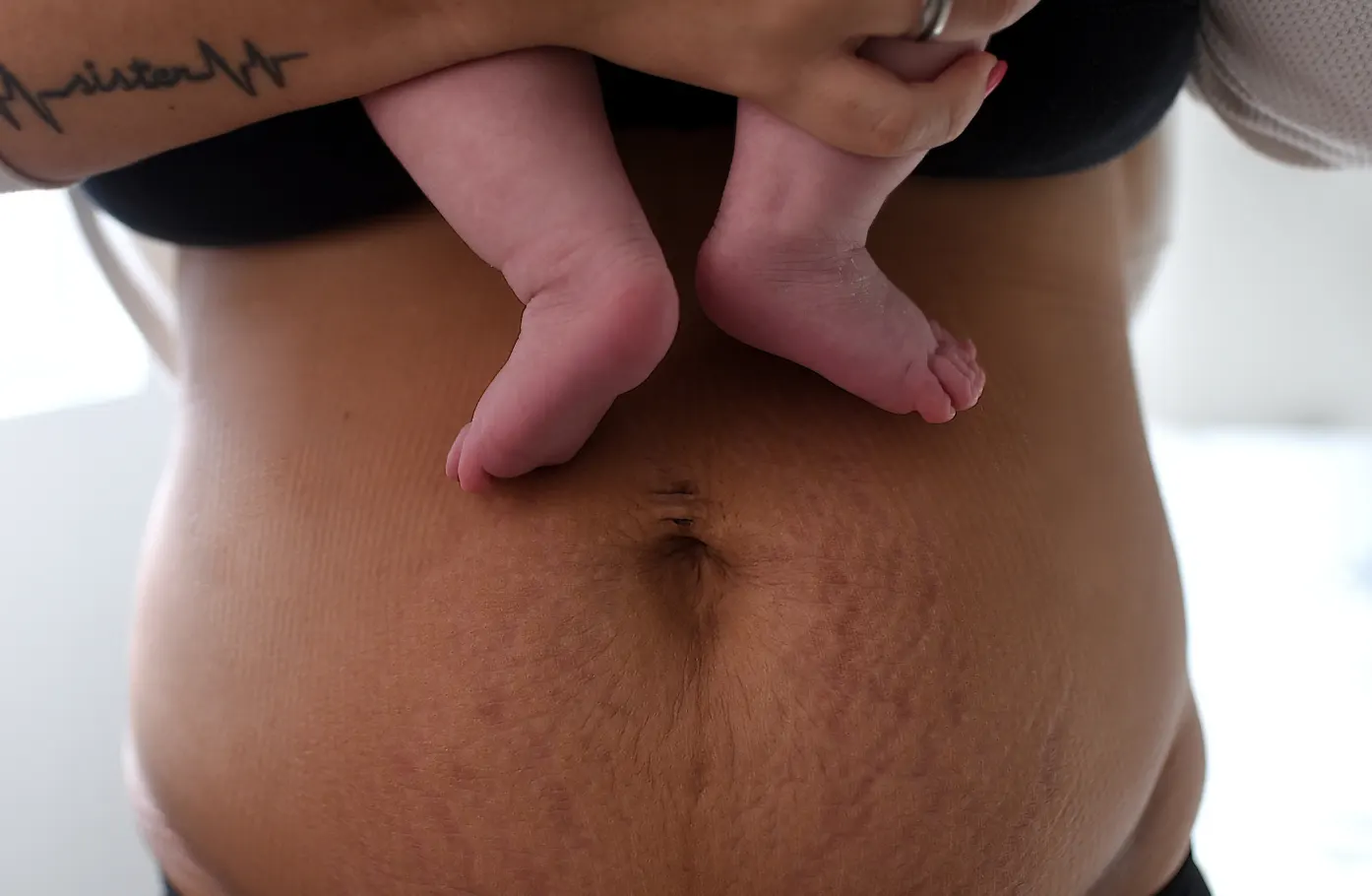 Postpartum BreastfeedingWhy Many Women “Eat Well” but Still Experience Persistent Hair Shedding