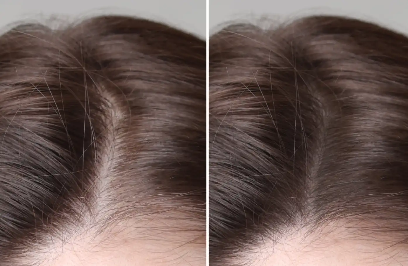 Hair Regrowth vs Density Recovery Why They’re Not the Same Thing