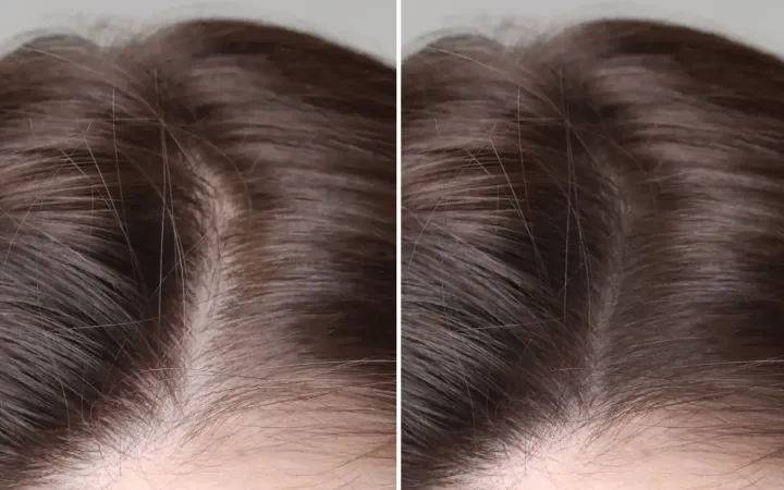 Hair Regrowth vs Density Recovery Why They’re Not the Same Thing