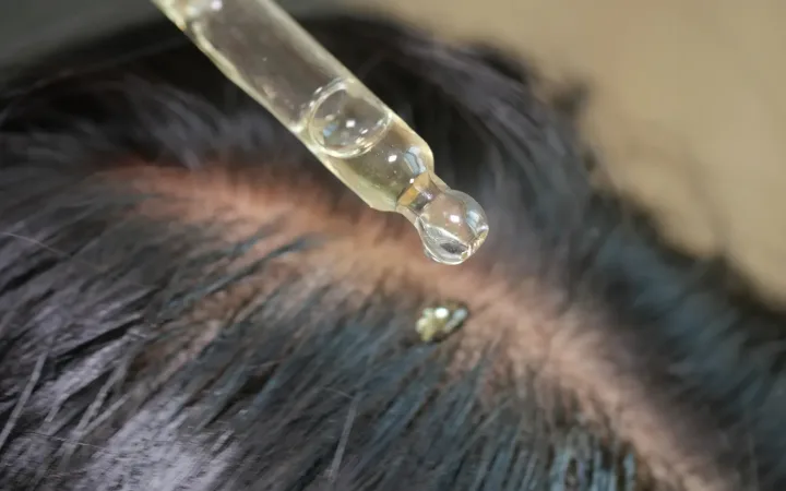 “Is Less Oil Always Better” Why Hormonal Oily Scalps Are More Vulnerable to Harsh Cleansing