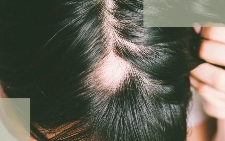 Scalp Environment Management Stabilizing the Micro-Ecosystem for Faster Postpartum Hair Recovery