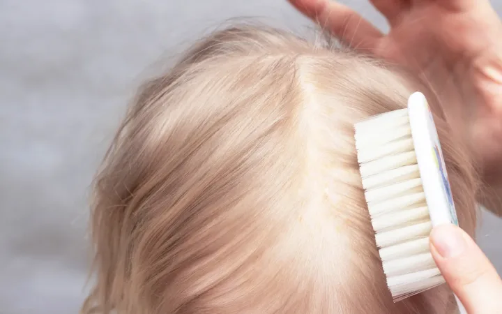 Seborrheic Dermatitis and Hormonal Hair Loss:Which Is the Cause — and Which Is the Amplifier?