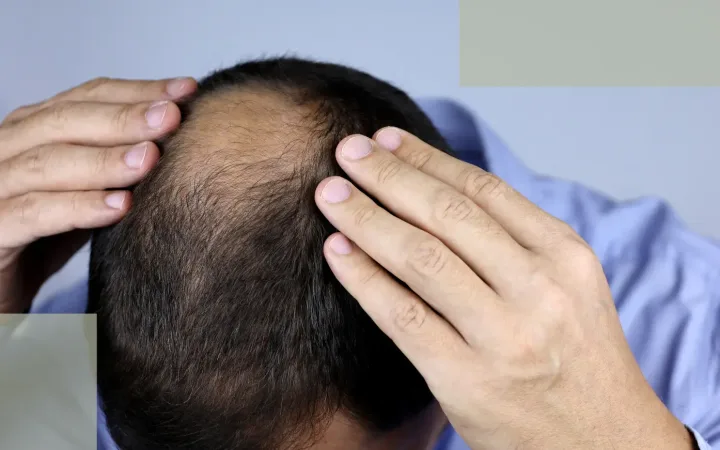 Seborrhoeic Dermatitis and Hair Loss How to Calm Your Scalp (1)